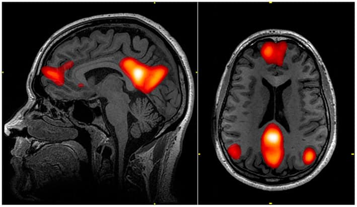 Magnetic resonance imaging of brain regions of the default mode network shown in bright orange on a gray brain image background.